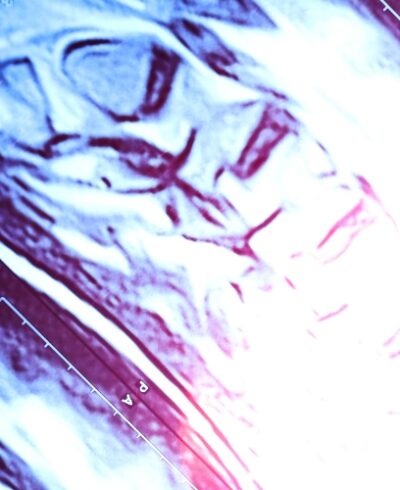 Non-destructive testing in casting - X-ray radiographic inspection of aerospace investment casting at Uni Tritech NADCAP NDT lab